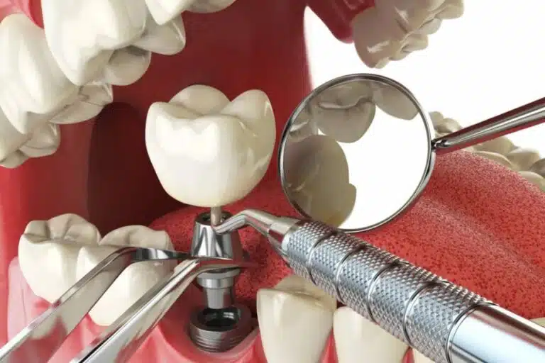 Differences Between Full Mouth Implants and Dental Bridges